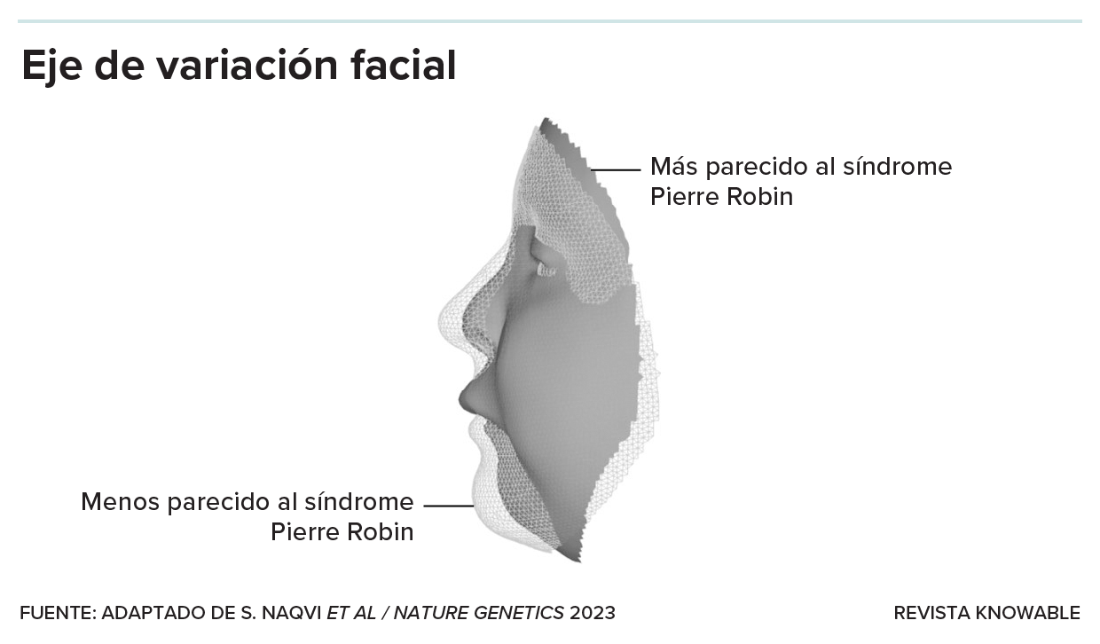 El síndrome de Pierre Robin (PRS) es un trastorno craneofacial caracterizado en parte por una mandíbula inferior pequeña, causado por una mutación en el gen regulador SOX9. Los investigadores clasificaron los rostros normales según si se parece mucho o poco a los rasgos del PRS y luego buscaron variantes genéticas asociadas. Así hallaron que algunos genes son muy sensibles a SOX9, lo que marca la variación facial acercándose o alejándose de los rasgos similares a los del PRS. Si otros ejes de variación facial se determinan de manera similar, esto podría significar que la genética de los rostros puede ser más simple de lo que parece.