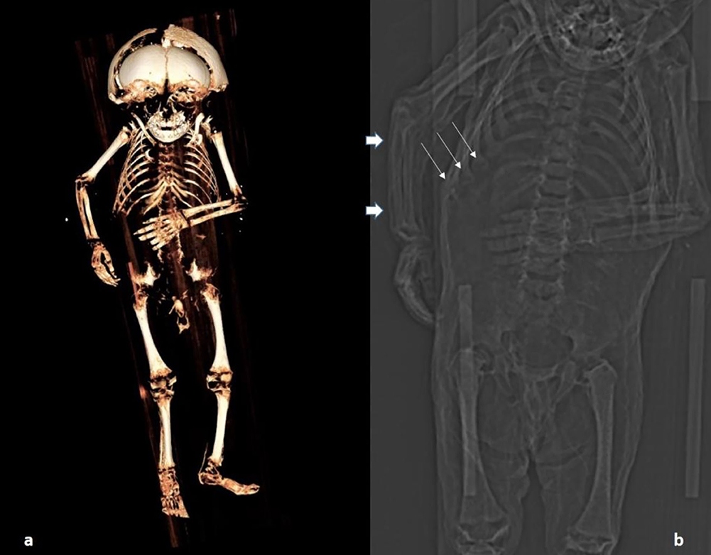 La autopsia virtual que permitió identificar a un niño momificado del siglo XVI
