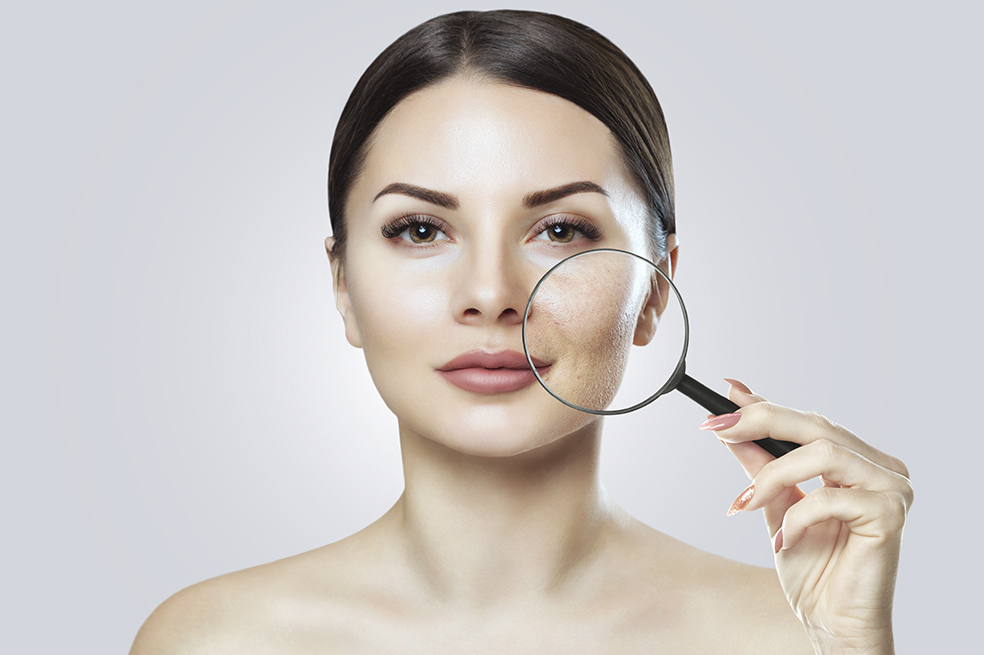 ¿Cómo eliminar las manchas del acné en el rostro?