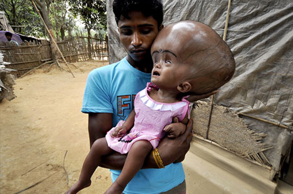 La niña india que padece hidrocefalia fue operada con éxito