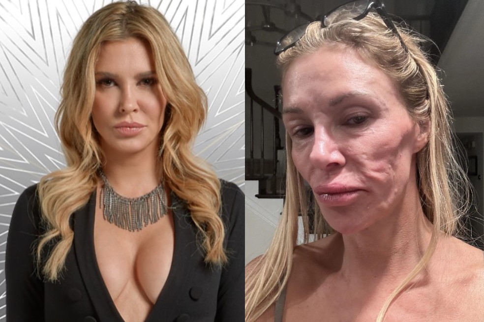 Famosa exmodelo se desfiguró el rostro. Implantes mamarios le causaron parásitos faciales