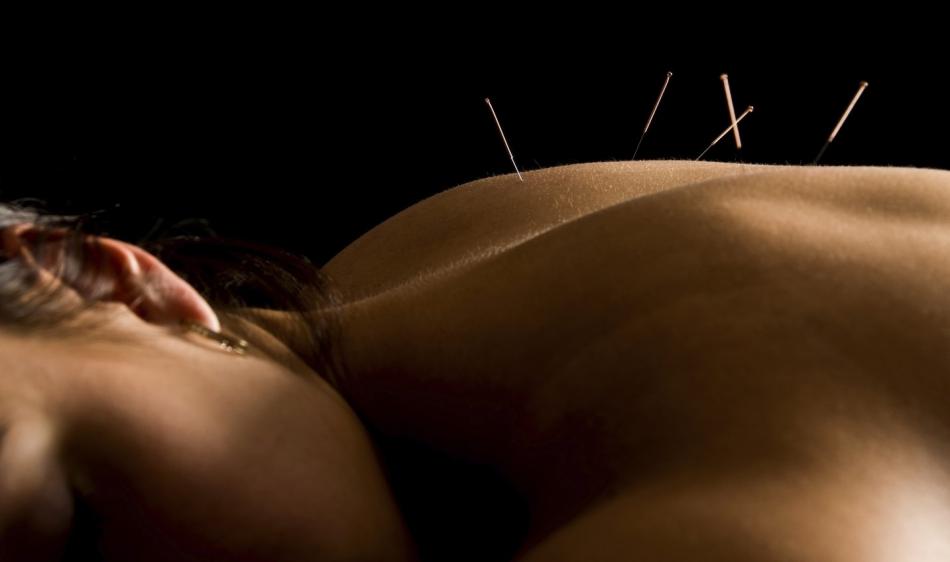 Cuatro beneficios de la acupuntura
