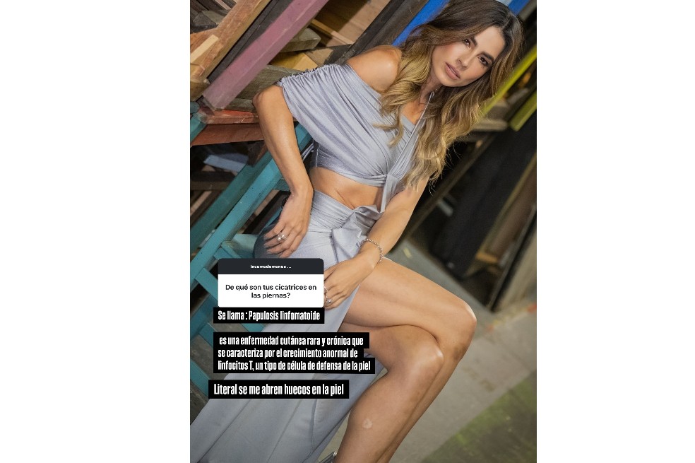 La actriz reveló que esa enfermedad ha causado “huecos en la piel” que han sido notorios en las fotografías que sube a sus redes sociales.
