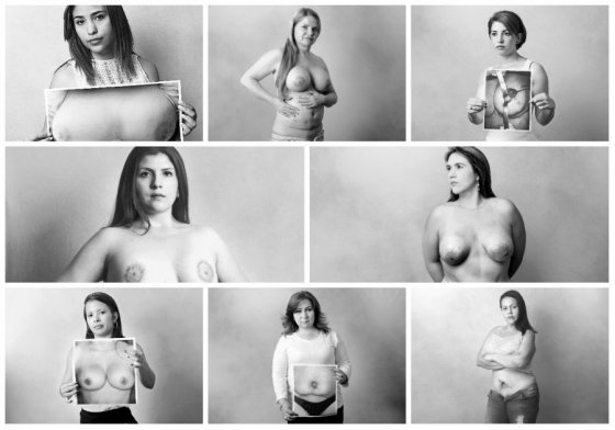En la edición del 2 de junio de El Espectador, varias mujeres víctimas de cirugías decidieron mostrar sus cicatrices. / Cristian Garavito - El Espectador