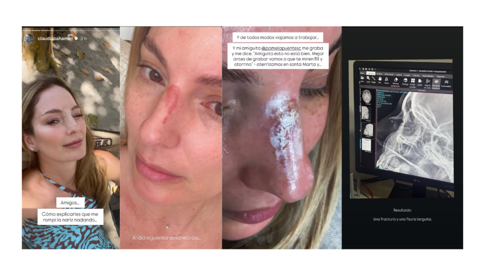 Claudia Bahamón sufrió accidente en medio de grabaciones de ‘MasterChef’. Así quedó su cara