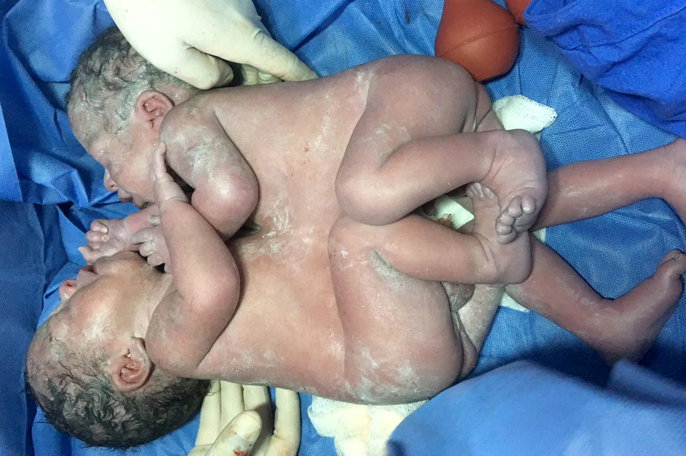Separan con éxito a siameses mexicanos unidos por tórax y abdomen