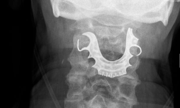 Médicos sugieren retirar dentaduras postizas antes de poner anestesia general