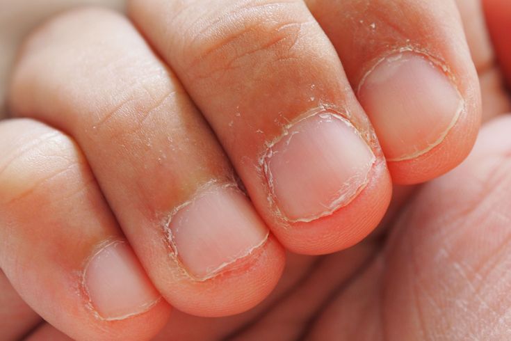 A menudo morderse las uñas, se asocia con nerviosismo o simplemente como un mal hábito, pero en realidad, puede estar relacionado con factores psicológicos más profundos.