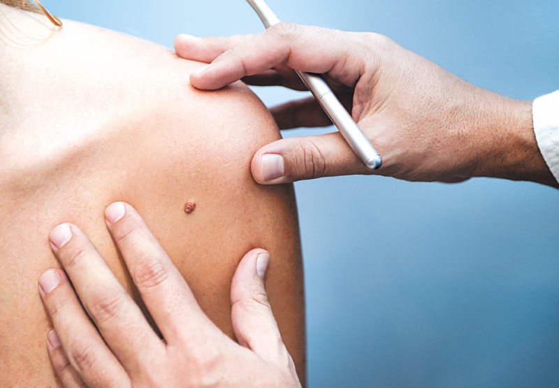Una victoria de la ciencia contra el cáncer de piel
