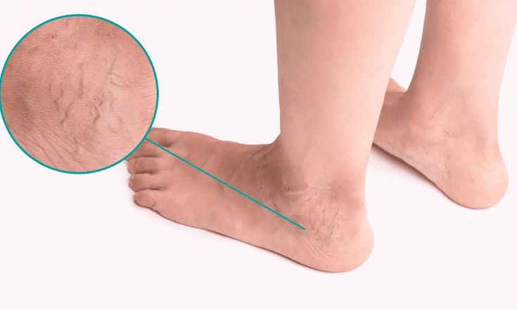 Esta receta es perfecta para reducir las venas varices de forma natural