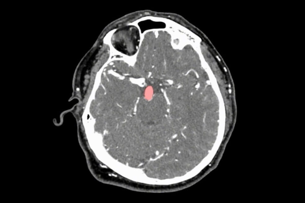 Diseñan un algoritmo que ayuda a encontrar aneurismas en el cerebro