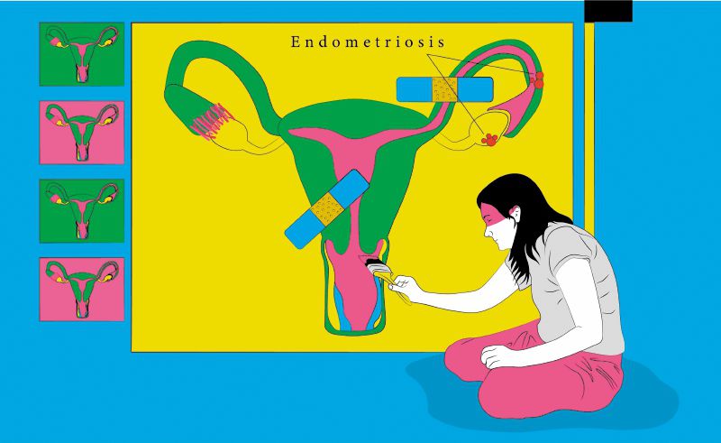 Gobierno publica política para prevenir, diagnosticar y tratar la endometriosis