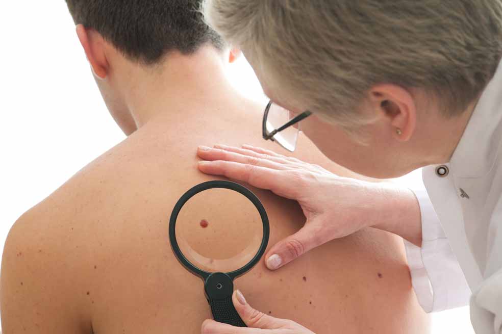 El cáncer de piel en Colombia ha aumentado de manera significativa