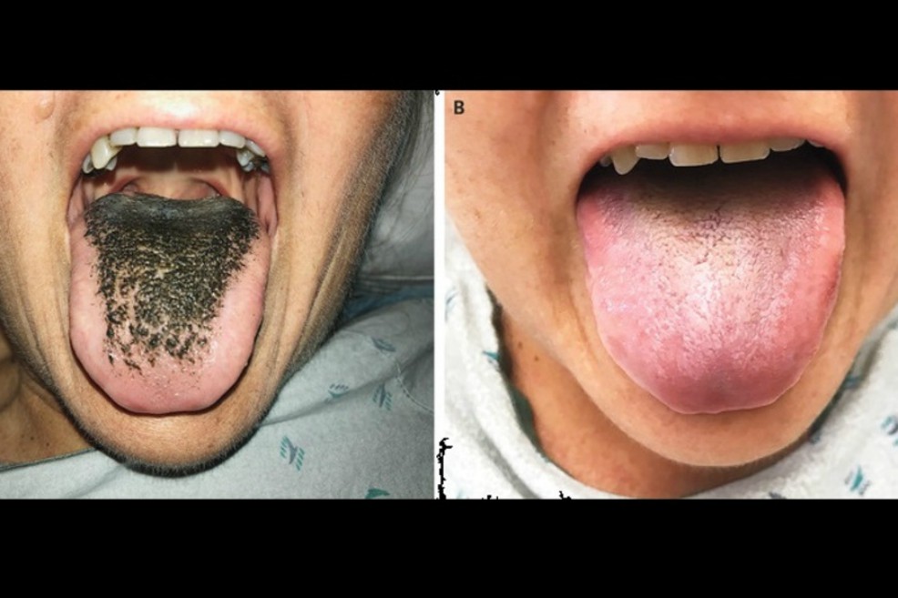El particular caso médico de la “lengua peluda negra” que se presentó en EE.UU.