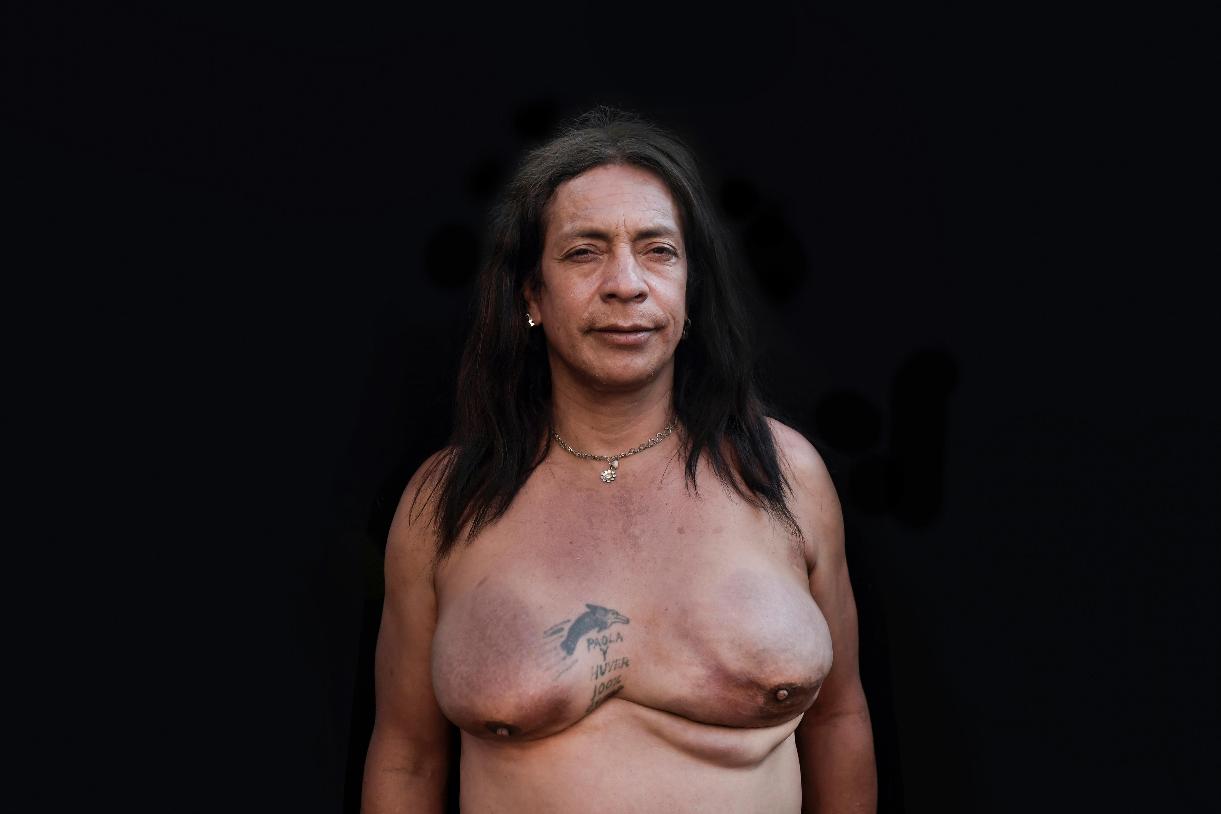 Paola: “Las que quedamos vivas cargamos con un cáncer que nos carcome día a día” dice. La presión en su hogar, sumado a las terapias de conversión, violencia sexual y el desplazamiento, la obligaron a huir de su casa a los 15 años y empezar una transición a escondidas. Al darse cuenta que el Vacanol –una hormona para ganado– ya no le funcionaba, decidió pagar $600.000 para que le inyectaran silicona. Me hicieron senos, piernas y culo. Casi diez horas con una jeringa de 50 milímetros” cuenta Paola. Actualmente, tiene problemas al orinar, siente mareo, fatiga y sus senos están destruidos, aún guarda la esperanza de que el sistema de salud haga algo por ella.