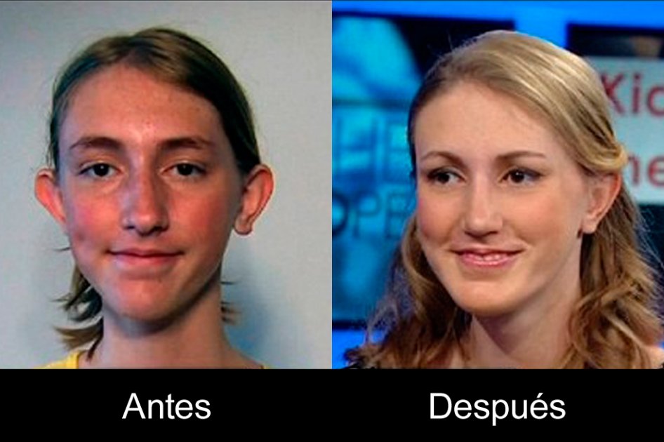 Con 14 años, esta niña ya se ha realizado tres cirugías plásticas