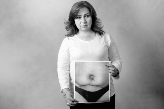 Adriana Guerrero
54 años
Lugar: Bogotá
Cirujano: Fabián Enrique Blanchar