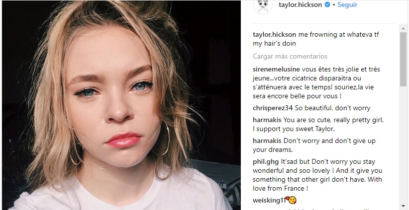 Taylor Hickson, la actriz que terminó desfigurada en rodaje de película de terror