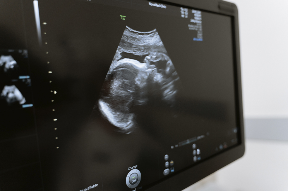 ¿Qué es un embarazo ectópico y por qué representaría la muerte inminente del bebé?