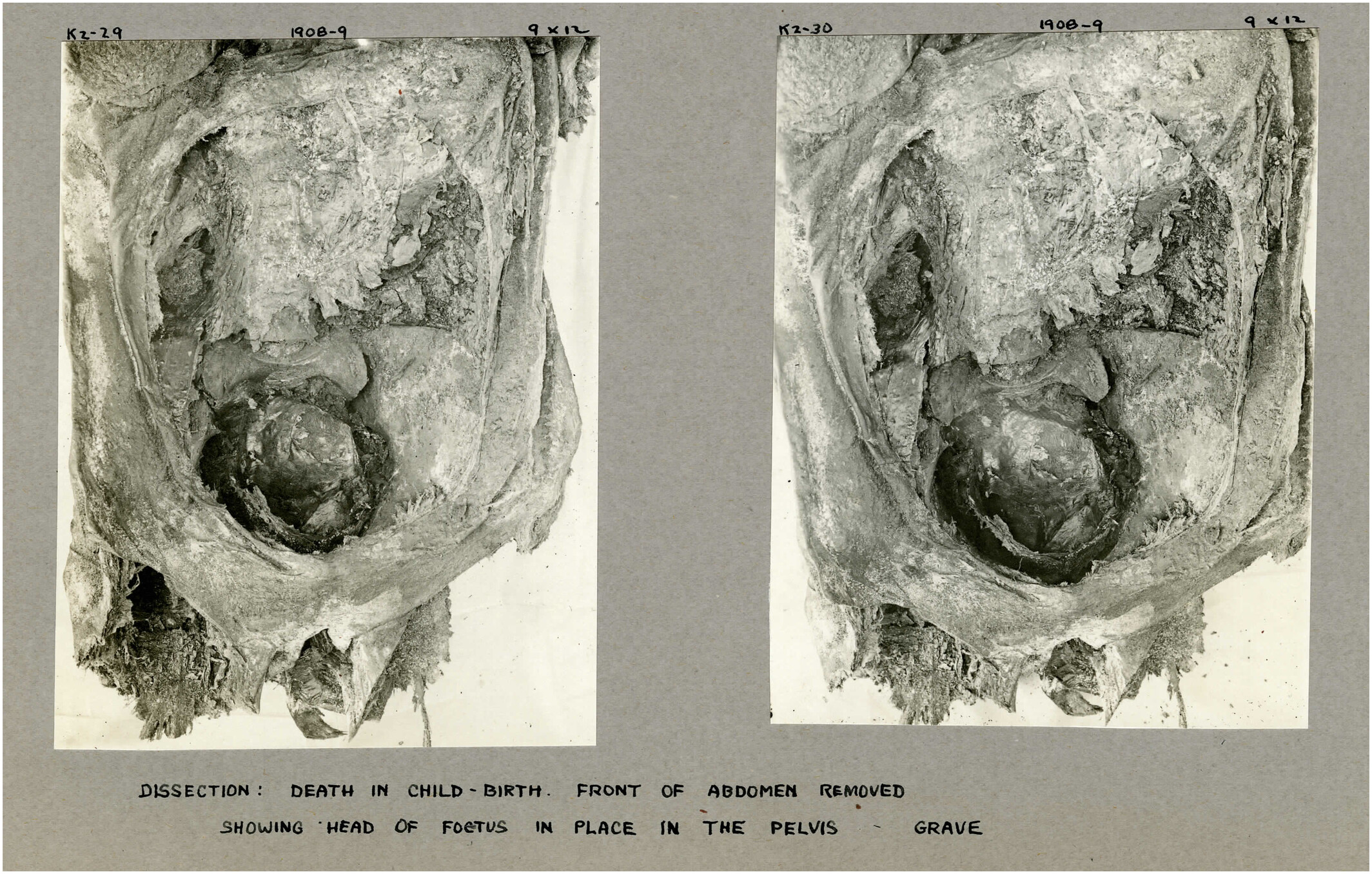 Estado desenvuelto y parcialmente disecado de la momia. / International Journal of Osteoarchaeology.