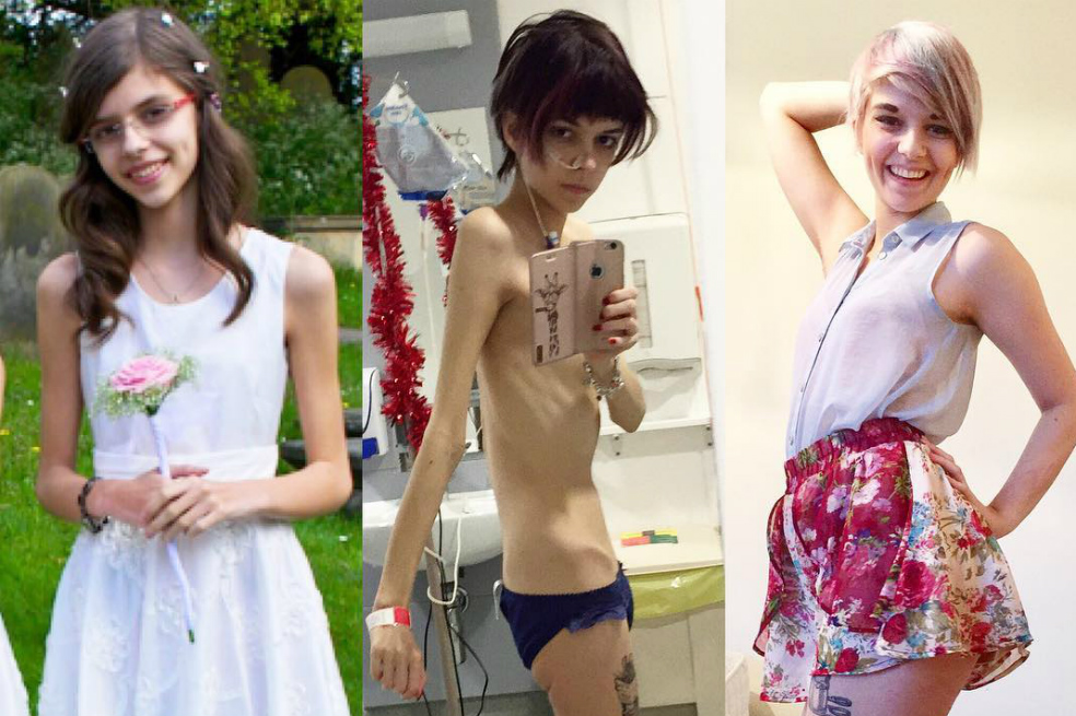 La joven británica que documenta cómo ganarle a la anorexia