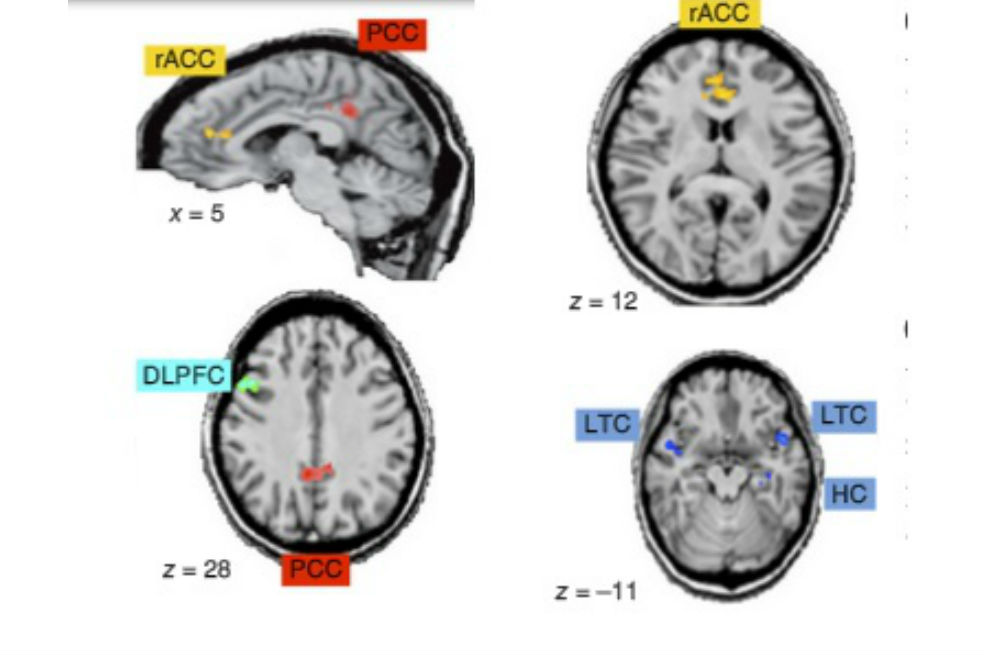 Así actúa un cerebro cuando juega ajedrez