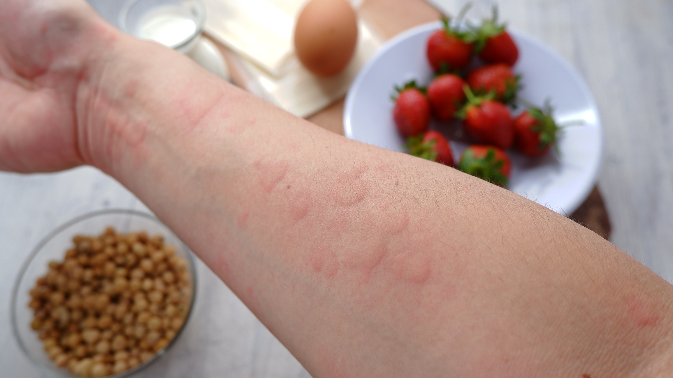 Alergias alimentarias