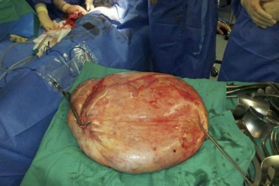 Imagen del tumor benigno de 25 kilos extraído a una mujer en 2013 en el Hospital de Torrevieja (Alicante). EFE/Hospital de Torrevieja