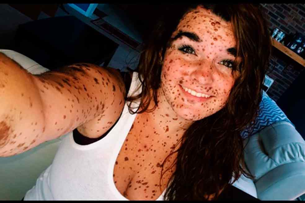 La joven con manchas en la piel que superó el bullying