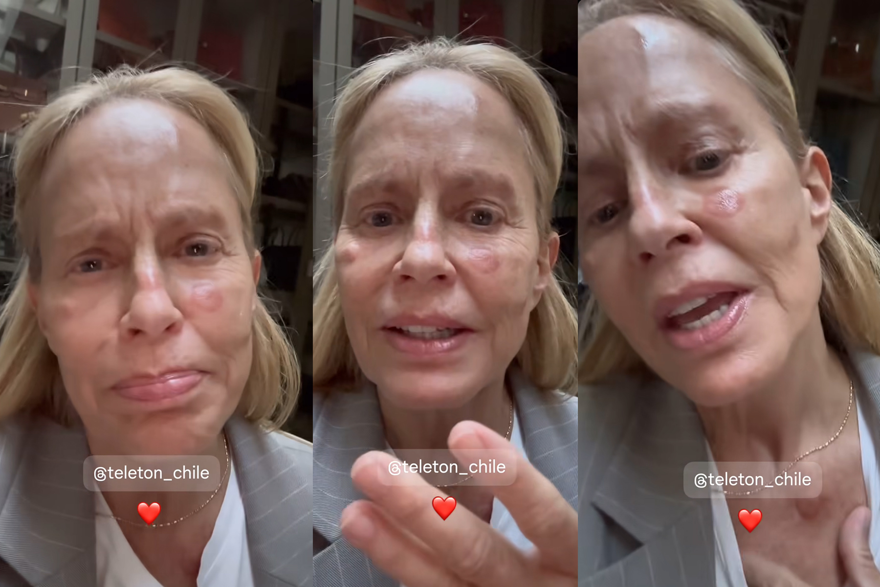 Cecilia Bolocco, de ‘Betty la fea’, preocupó por heridas en su cara. ¿Qué le pasó?