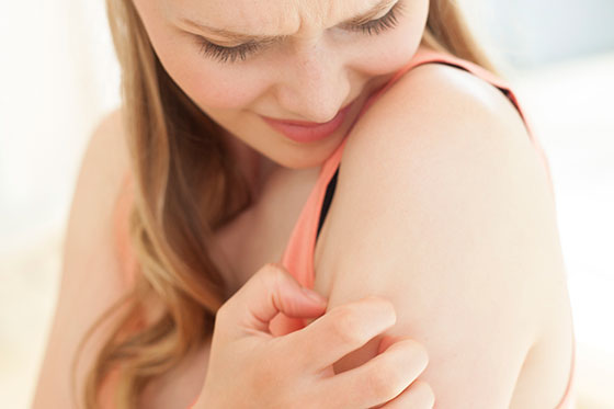 Tips para evitar y cuidar las picaduras de los mosquitos