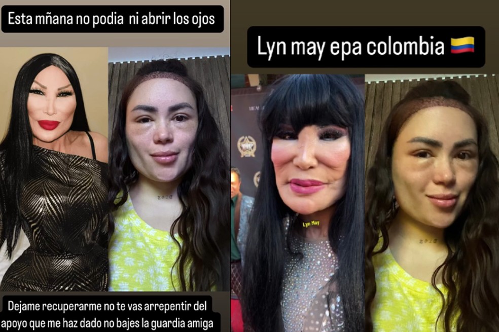 Al parecer, la anestesia del trasplante capilar al que se sometió recientemente Epa Colombia le produjo una hinchazón severa. Su rostro quedó irreconocible.
