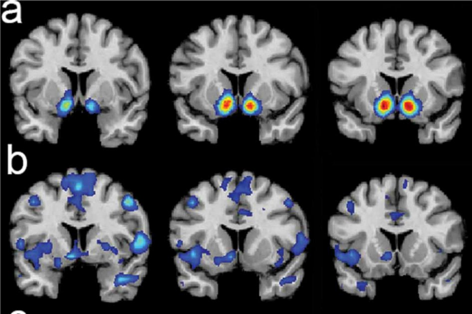 Las experiencias religiosas activan los circuitos de recompensa del cerebro