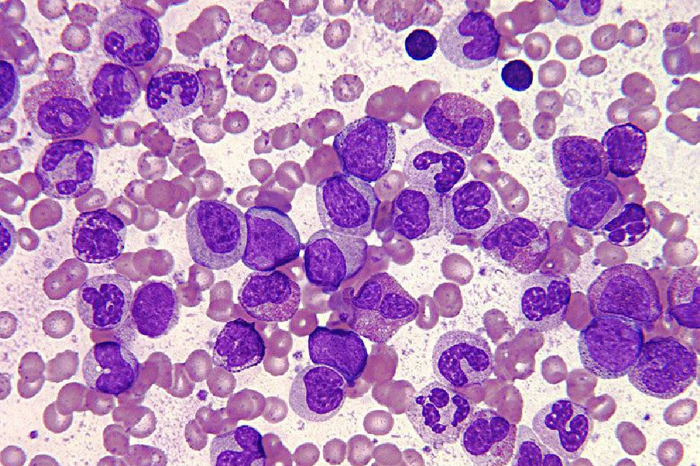Revolución médica contra la leucemia