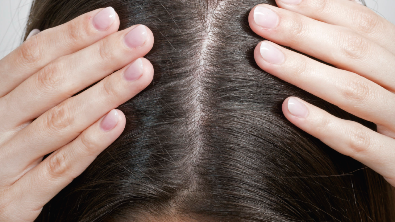 ¿Qué se hace para quitar la caspa? Consejos para tratarla si sufres de este mal
