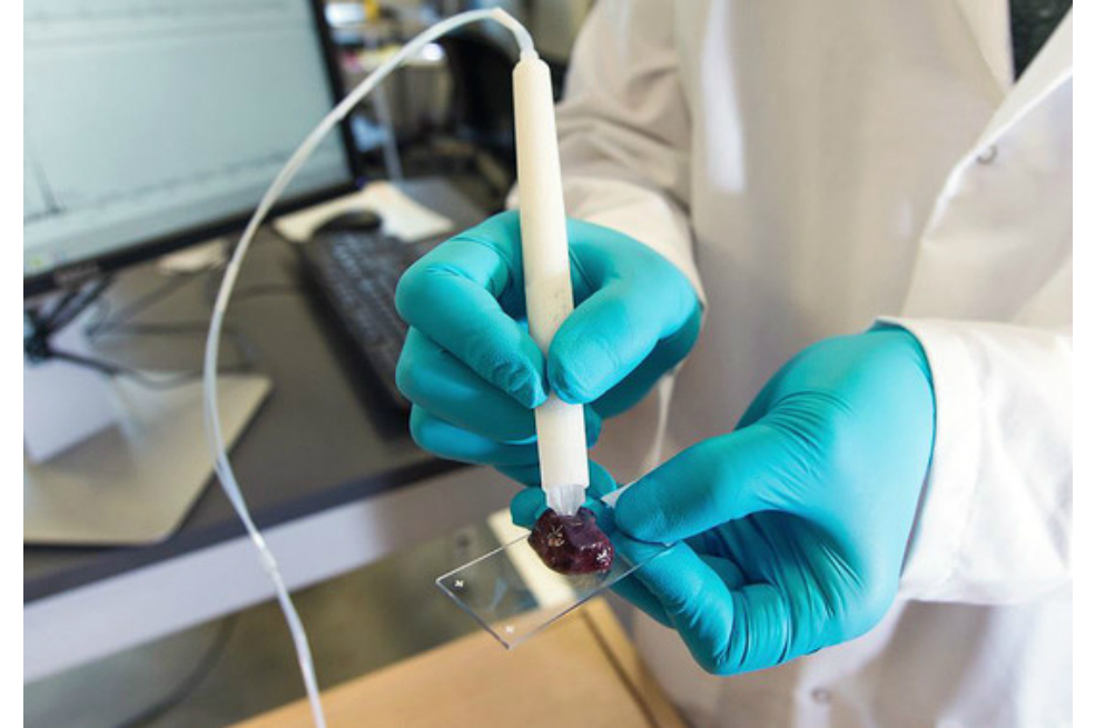 El dispositivo que identifica, en segundos, tejido canceroso durante una cirugía