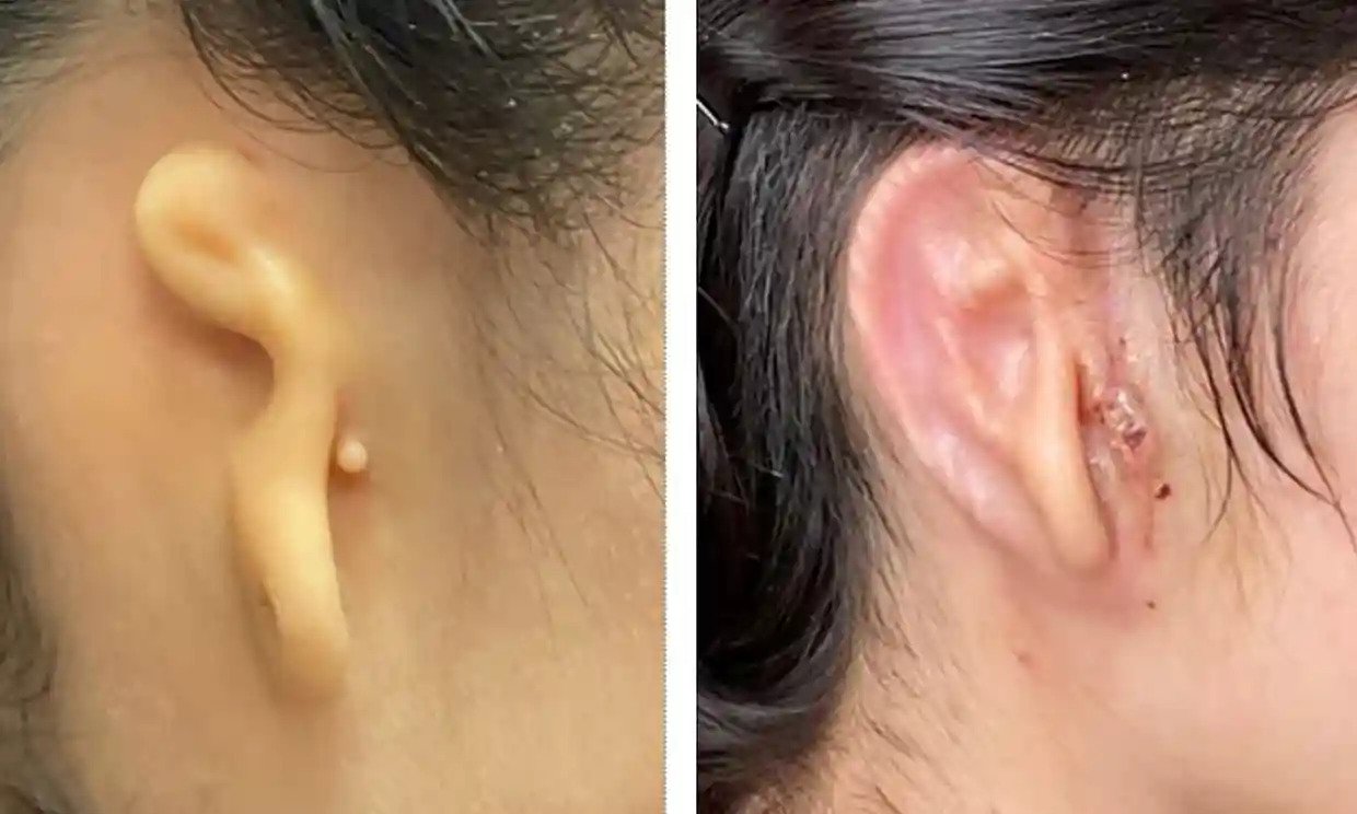 Médicos estadounidenses trasplantan oreja impresa en 3D y hecha de células humanas