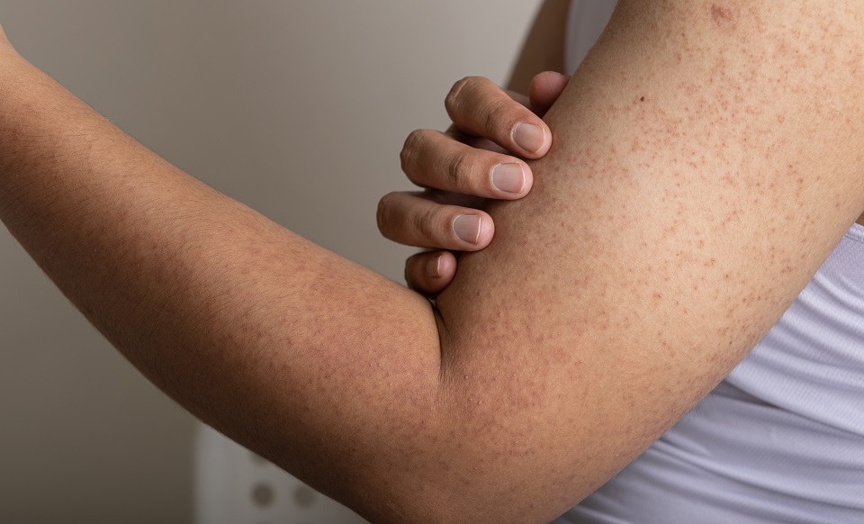 ¿Qué es y cómo deshacerse de la queratosis? También conocida como piel de gallina