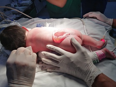 Mia Samara, la recién nacida que sobrevivió a una compleja intervención médica