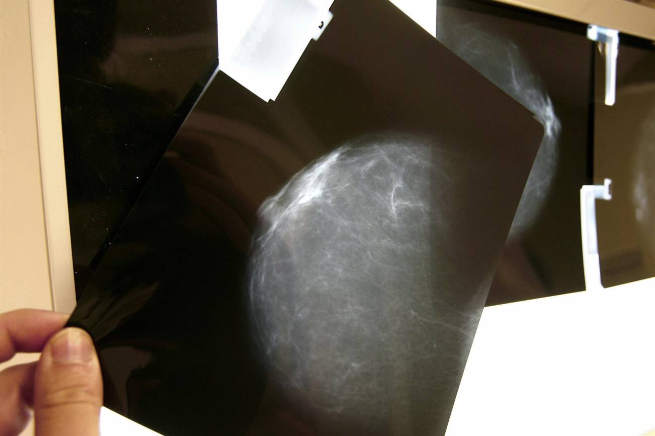Nuevo fármaco mejoraría la supervivencia de mujeres con cáncer de mama metastásico