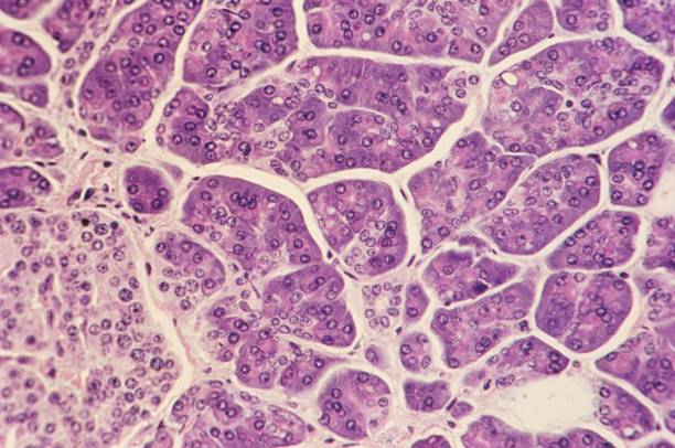 ¿Por qué el cáncer de páncreas puede ser tan agresivo? Un nuevo estudio ofrece pistas