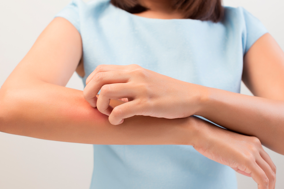 ¿Qué es la dermatitis atópica y cuándo es el día mundial de esta enfermedad?