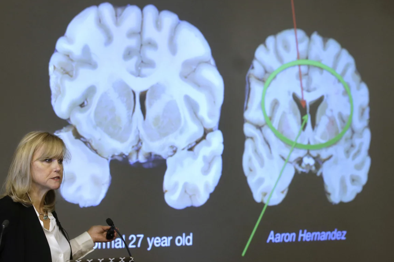 La doctora Ann Mkee, directoria del Centro CTE de la Universidad de Boston, exponiendo el caso de Aaron Hernández.