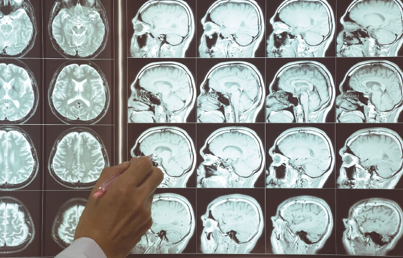 Estimulación cerebral profunda: ¿una alternativa para la depresión?