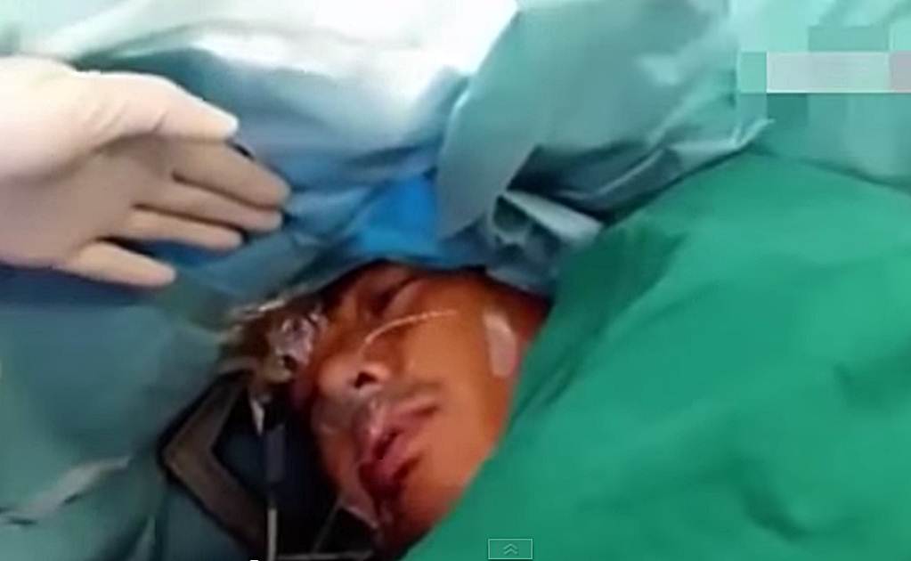 Video. Paciente despierta en plena operación cerebral
