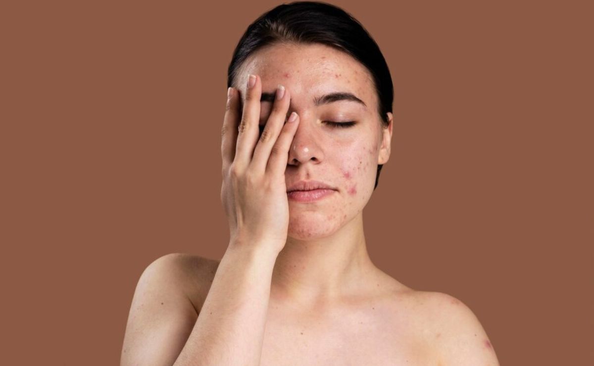 Conoce 3 mitos sobre el acné