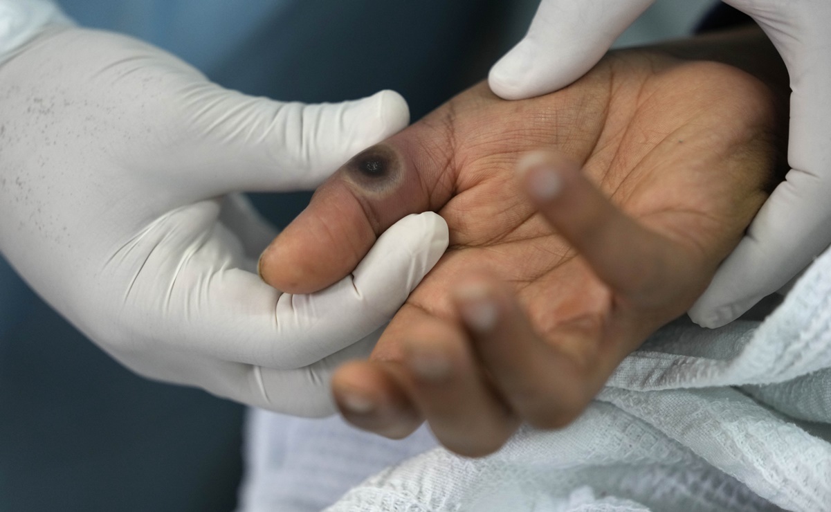 Secretaría de Salud reporta mil 627 casos de viruela símica en México 