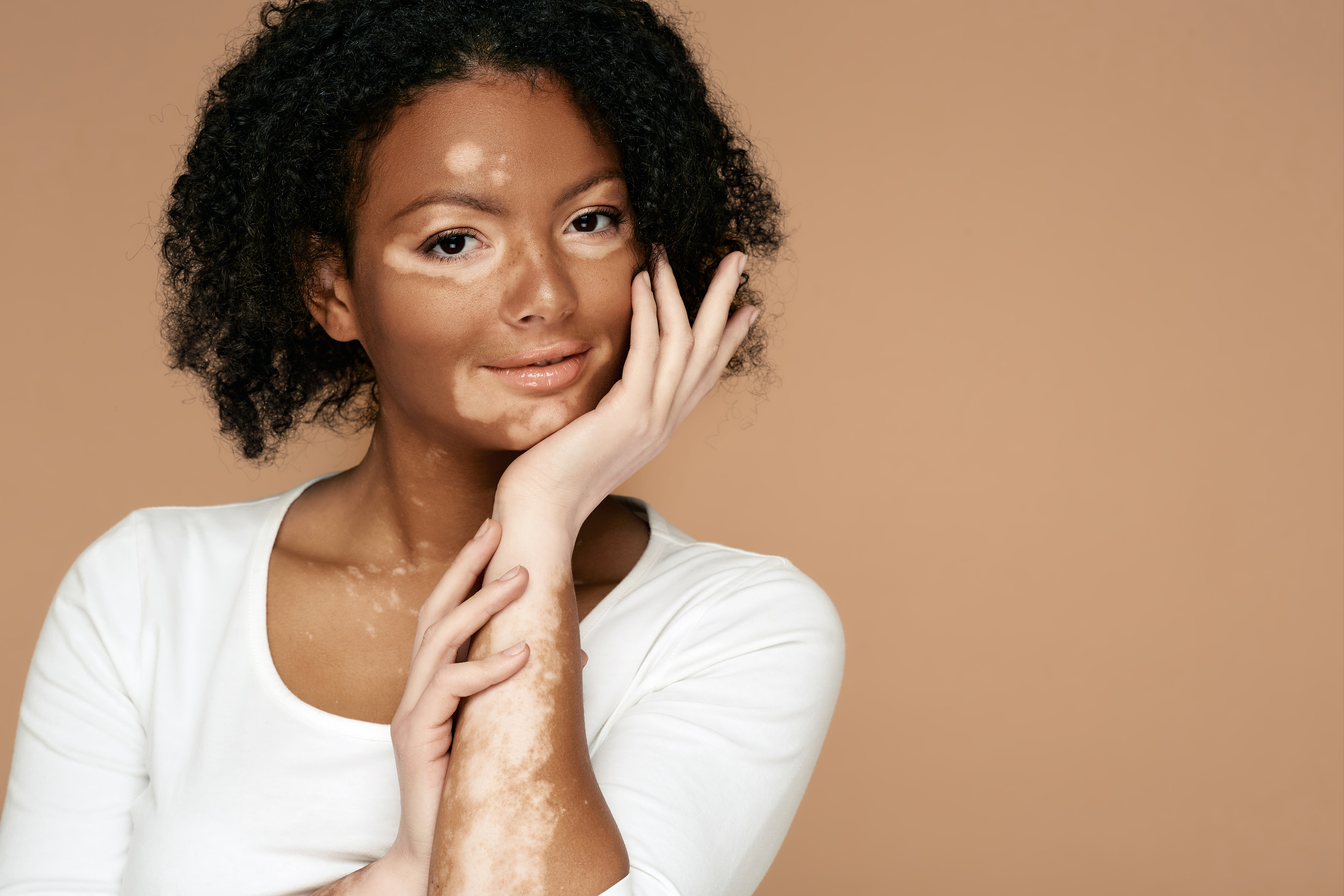 Día Mundial del Vitiligo: ¿Qué lo causa? ¿Hay cura? Esto dice Harvard