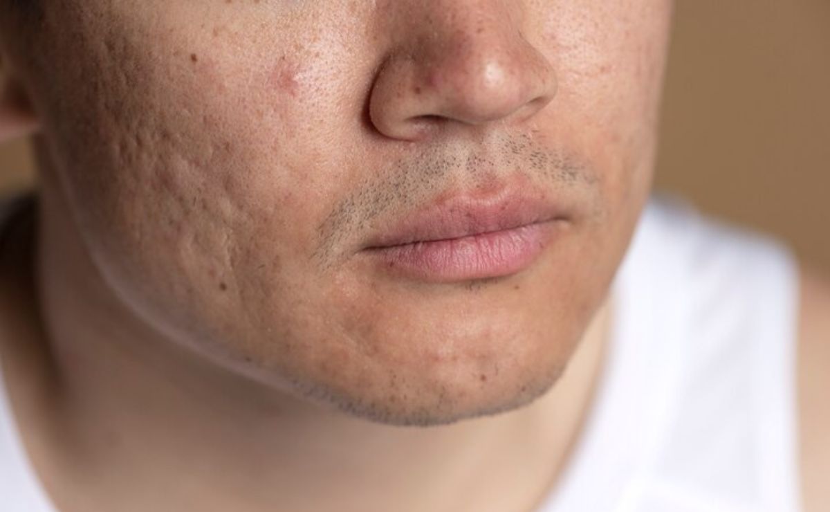 Aprende a combatir el acné en la barbilla