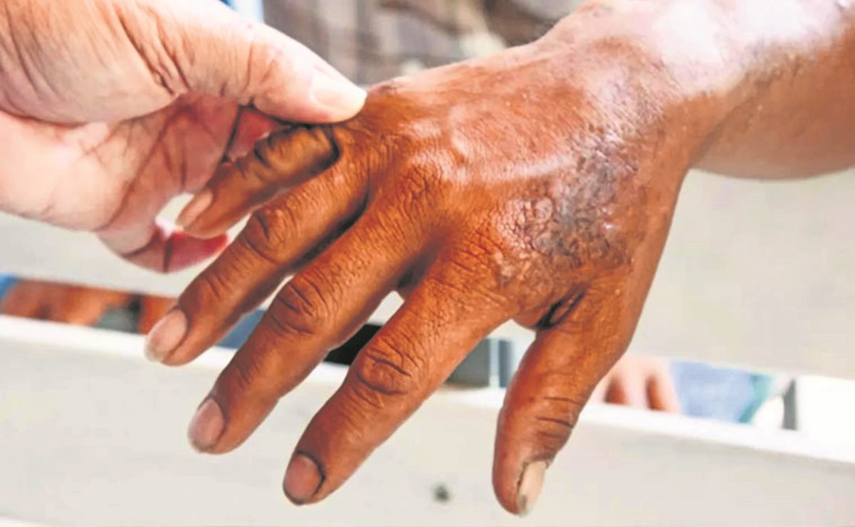 Día Mundial contra la Lepra: ¿qué bacteria provoca esta enfermedad?